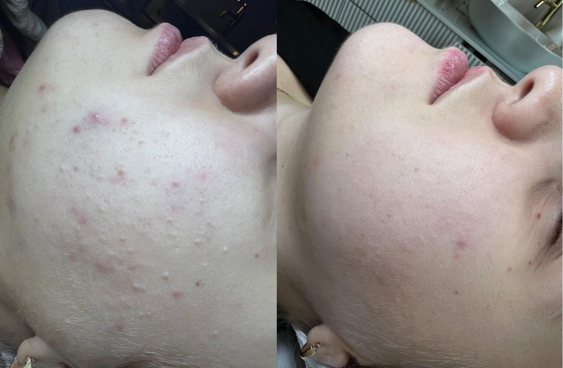 Efekty terapii trądziku w kosmetologii i medycynie estetycznej w Gdyni – przed i po zabiegach